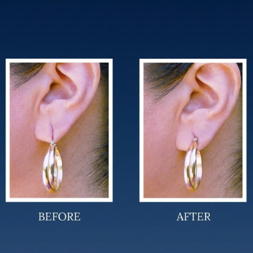 LobeCare™ (60 Patches) The ORIGINAL Ear Lobe Support Patches for Pierced Ears
